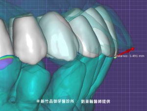 透過數位設計，可在術前事先設計未來假牙位置