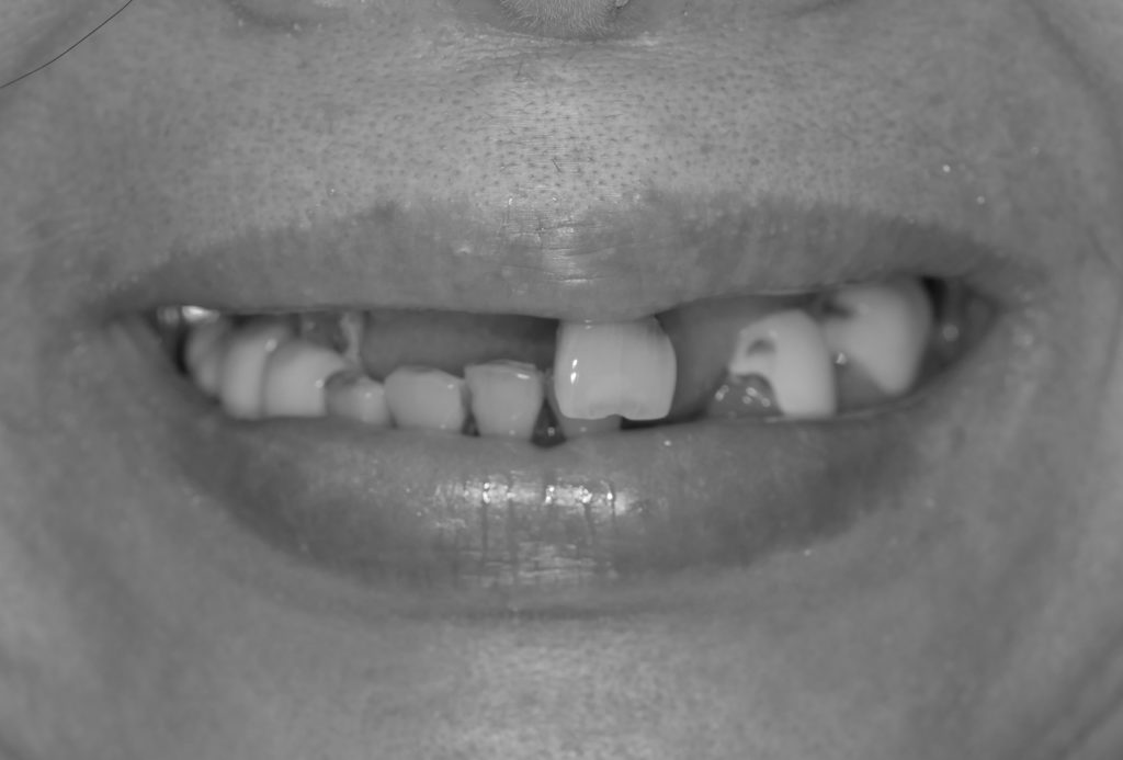 新竹 All-on-4 術前上顎，僅剩一顆牙